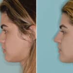 Rhinoplasty Before and After Photos in Miami, FL, Patient 6744