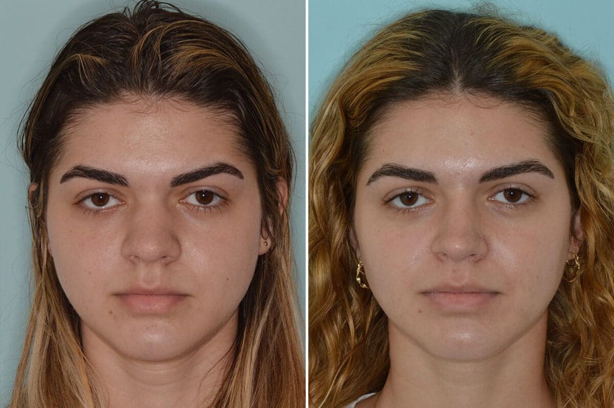 Rhinoplasty Before and After Photos in Miami, FL, Patient 6744