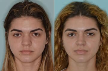 Rhinoplasty Before and After Photos in Miami, FL, Patient 6744