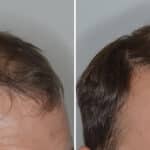 Hair Transplant Before and After Photos in Miami, FL, Patient 6909