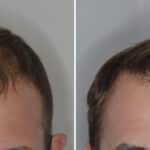 Hair Transplant Before and After Photos in Miami, FL, Patient 6909