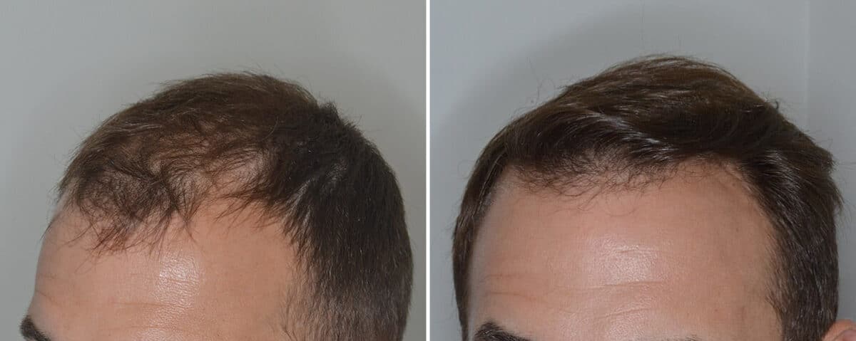 Hair Transplant Before and After Photos in Miami, FL, Patient 6909