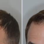 Hair Transplant Before and After Photos in Miami, FL, Patient 6909