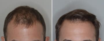 Hair Transplant Before and After Photos in Miami, FL, Patient 6909