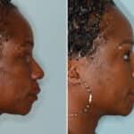Ethnic Rhinoplasty Before and After Photos in Miami, FL, Patient 6949