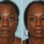 Ethnic Rhinoplasty Before and After Photos in Miami, FL, Patient 6949