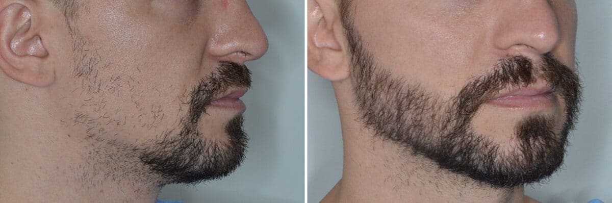 Beard Transplant Before and After Photos in Miami, FL, Patient 6956