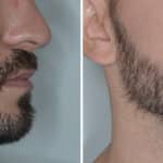 Beard Transplant Before and After Photos in Miami, FL, Patient 6956