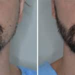 Beard Transplant Before and After Photos in Miami, FL, Patient 6956