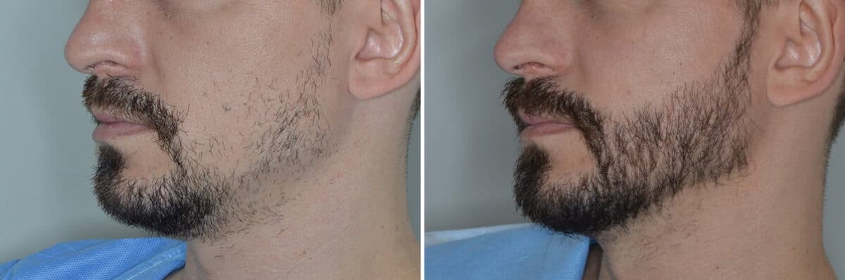 Beard Transplant Before and After Photos in Miami, FL, Patient 6956