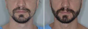 Beard Transplant Before and After Photos in Miami, FL, Patient 6956