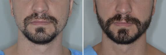 Beard Transplant Before and After Photos in Miami, FL, Patient 6956