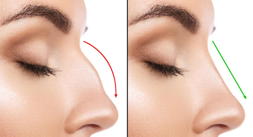 The procedure of rhinoplasty surgery for long-nosed women is a complex and precise process that requires skill and expertise.