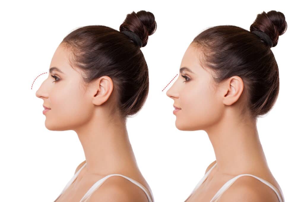 Rhinoplasty surgery for long-nosed women can greatly improve the shape and size of the nose, resulting in an aesthetically pleasing and improved nose.