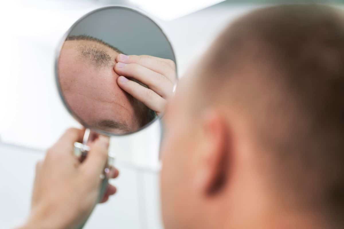 Person examining scalp with mirror to assess hair transplant quality.