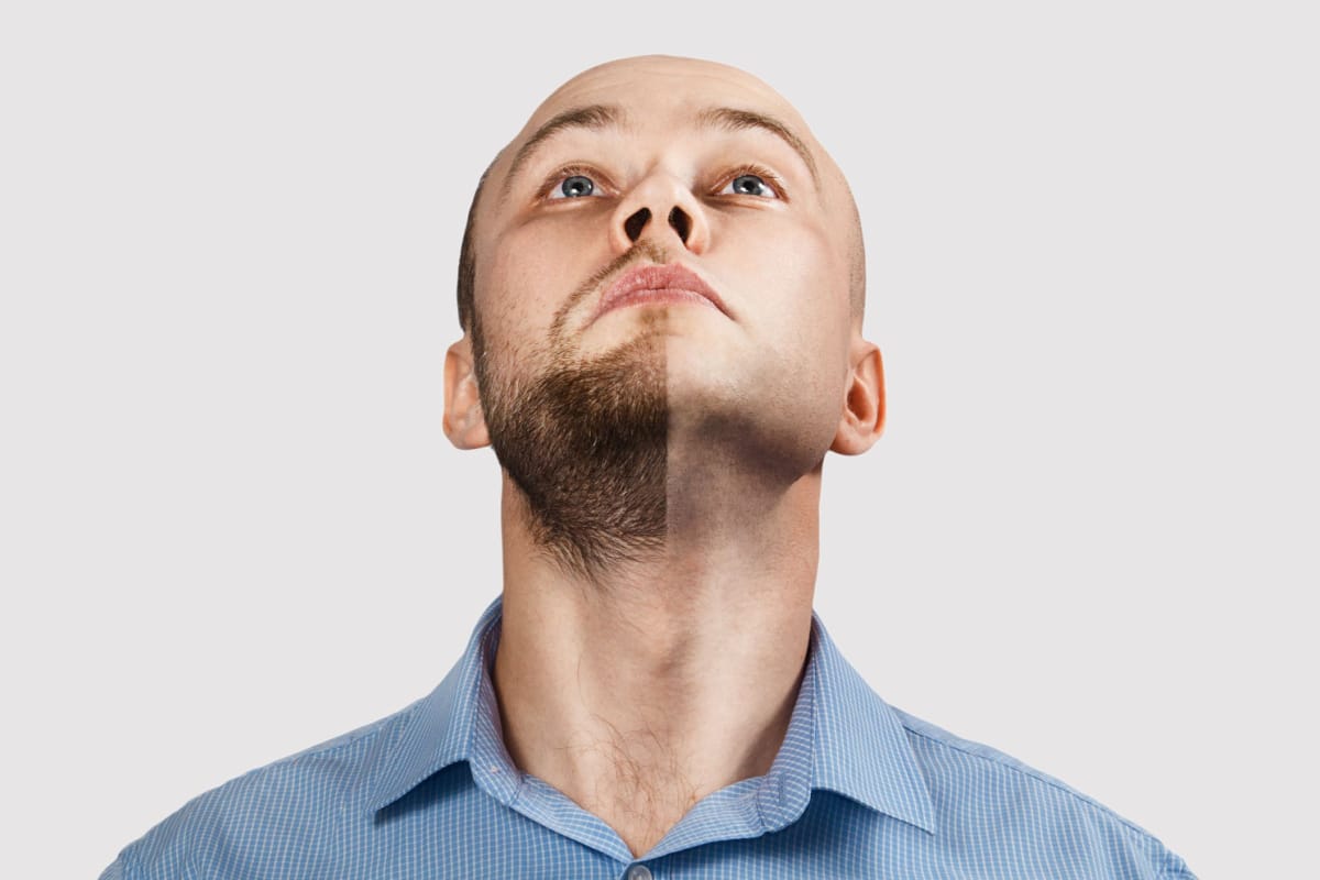 Beard Transplants: What You Need to Know