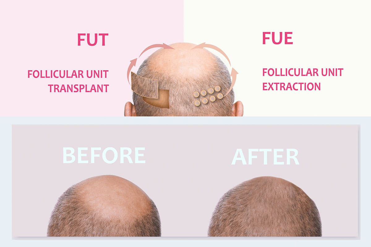 Comparison between the FUT and FUE Hair transplant techniques with a before and after at the bottom.