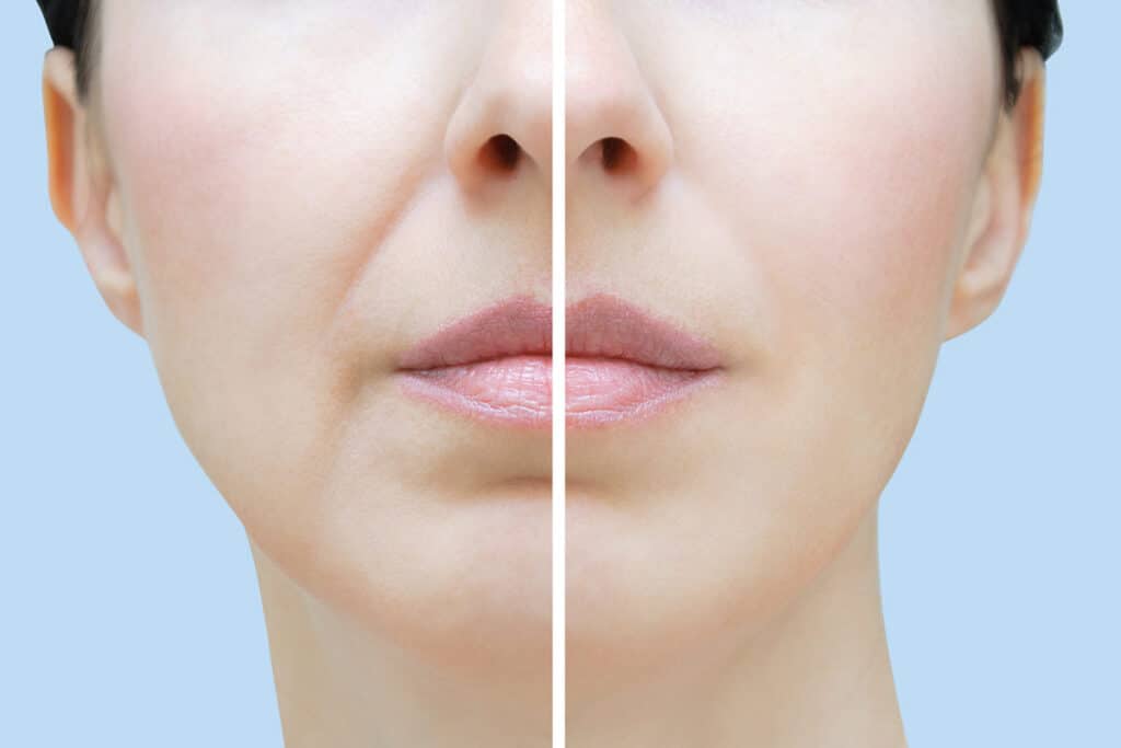 Before and after a Volbella treatment for the nasolabial folds and marionette lines.