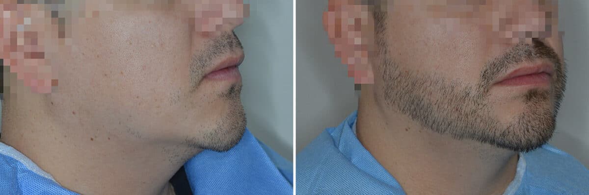 Beard Transplant Before and After Photos in Miami, FL, Patient 7118