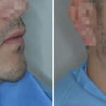 Beard Transplant Before and After Photos in Miami, FL, Patient 7118