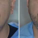 Beard Transplant Before and After Photos in Miami, FL, Patient 7118