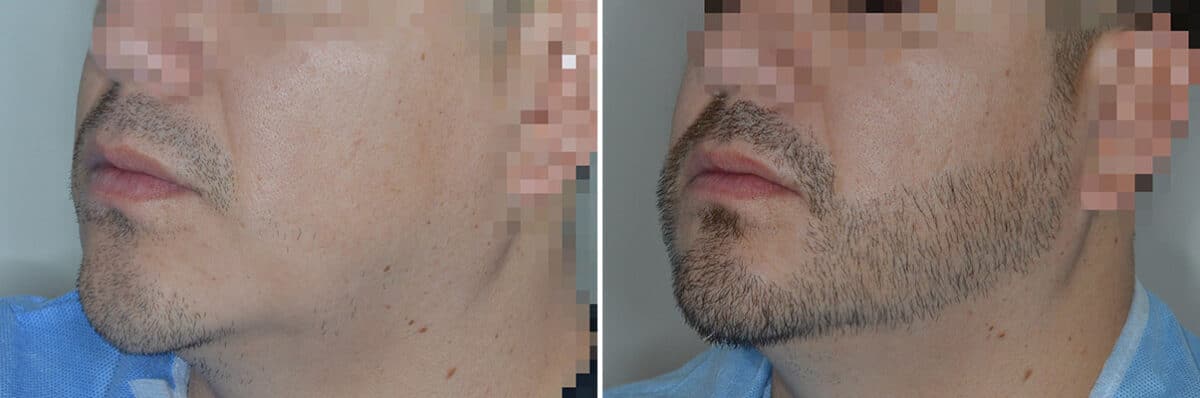 Beard Transplant Before and After Photos in Miami, FL, Patient 7118