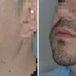 Beard Transplant Before and After Photos in Miami, FL, Patient 7118