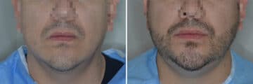 Beard Transplant Before and After Photos in Miami, FL, Patient 7118