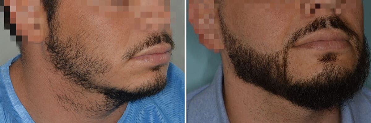 Beard Transplant Before and After Photos in Miami, FL, Patient 7491