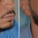 Beard Transplant Before and After Photos in Miami, FL, Patient 7491