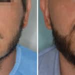 Beard Transplant Before and After Photos in Miami, FL, Patient 7491