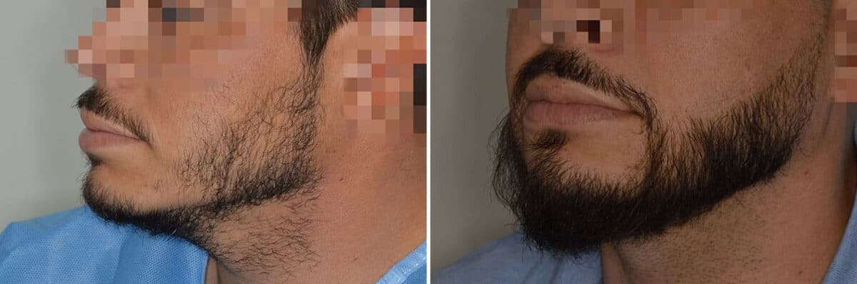 Beard Transplant Before and After Photos in Miami, FL, Patient 7491