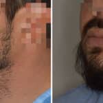 Beard Transplant Before and After Photos in Miami, FL, Patient 7491