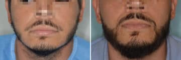 Beard Transplant Before and After Photos in , , Patient 7491