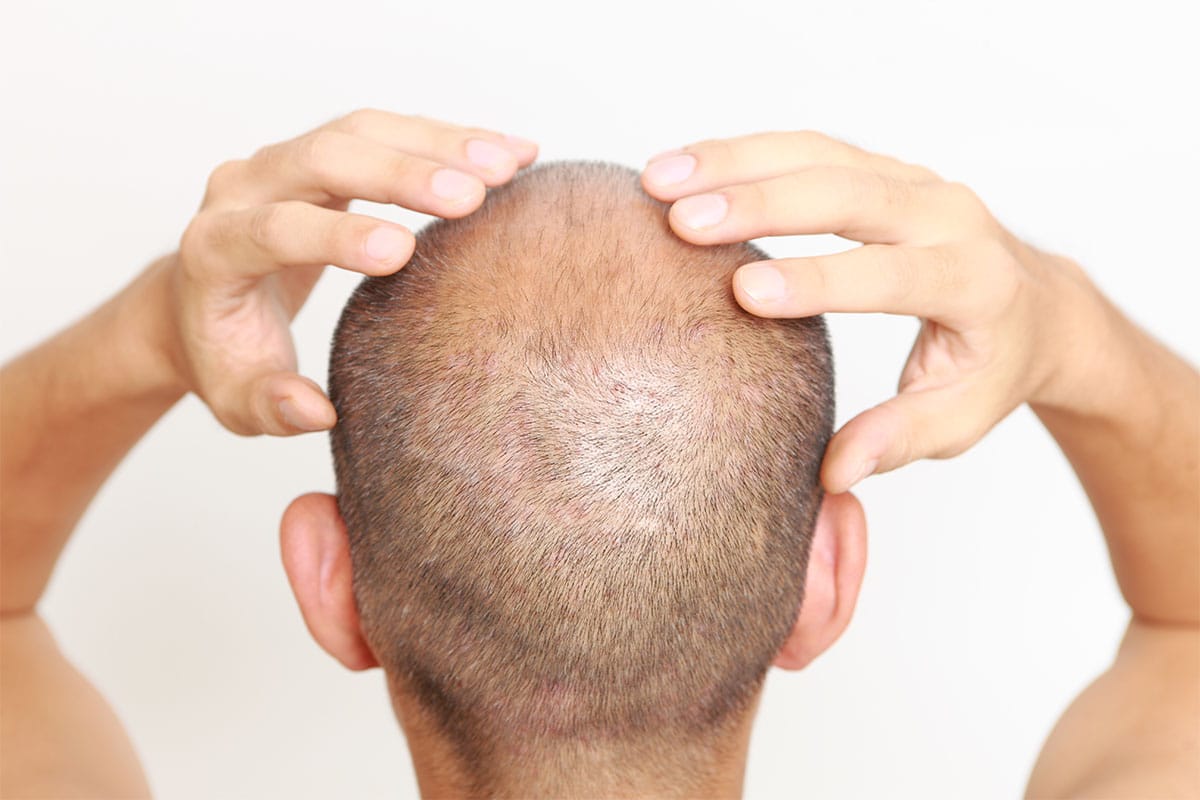 The Future of Hair Transplants: FUE Drill & Neograft Mastery