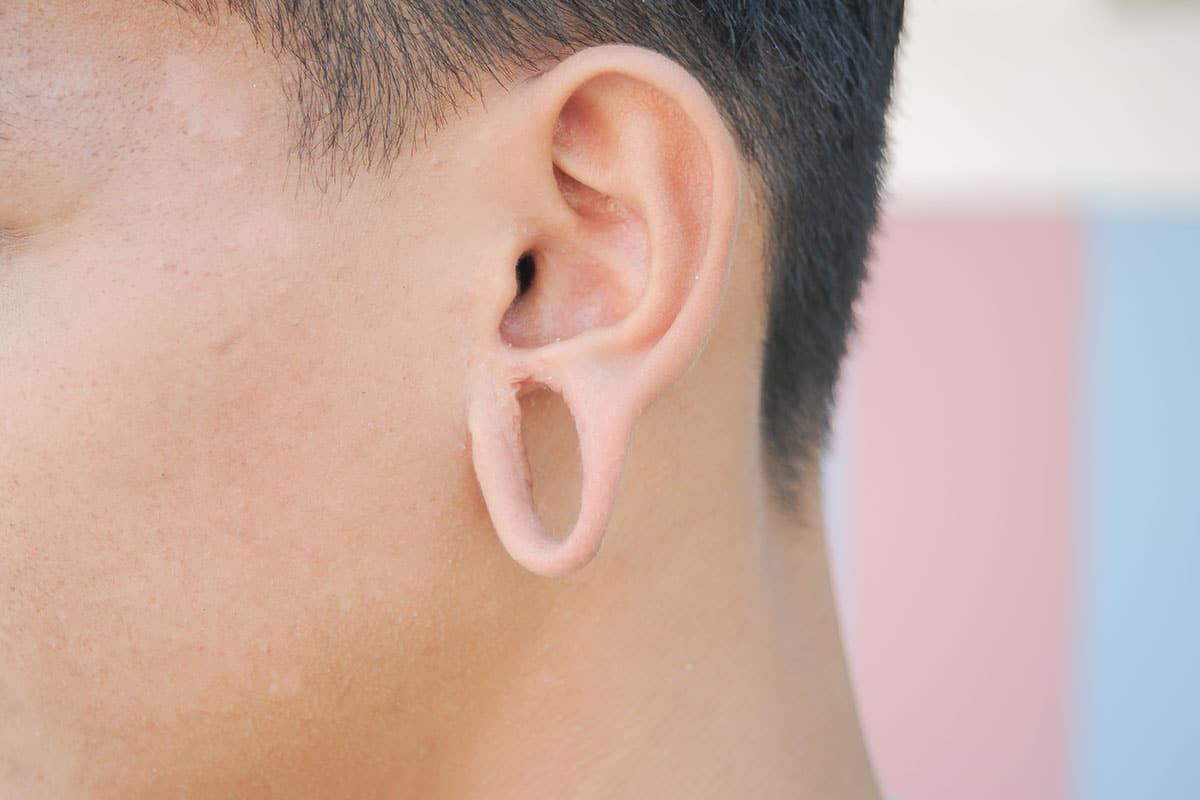 Stretched Earlobe Repair: Restoring Your Ear’s Appearance