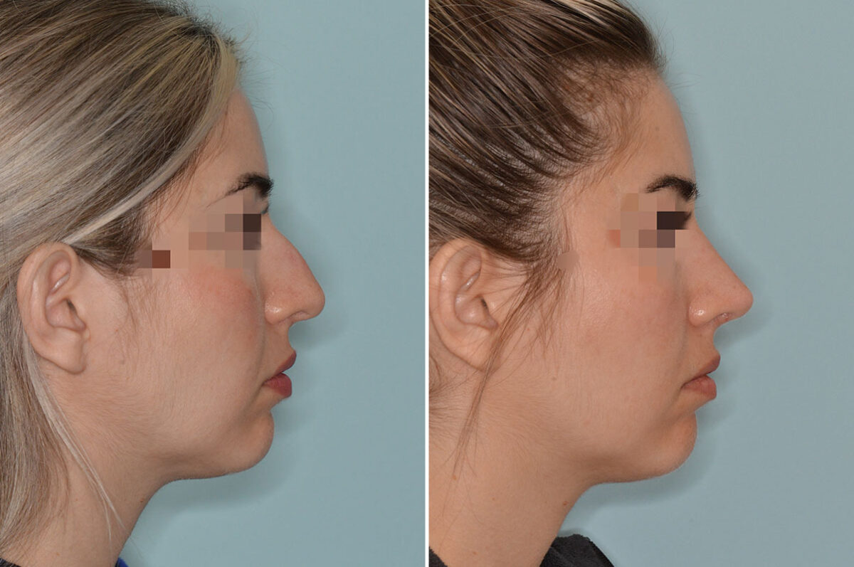 Rhinoplasty Before and After Photos in Miami, FL, Patient 7877