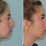 Rhinoplasty Before and After Photos in Miami, FL, Patient 7877