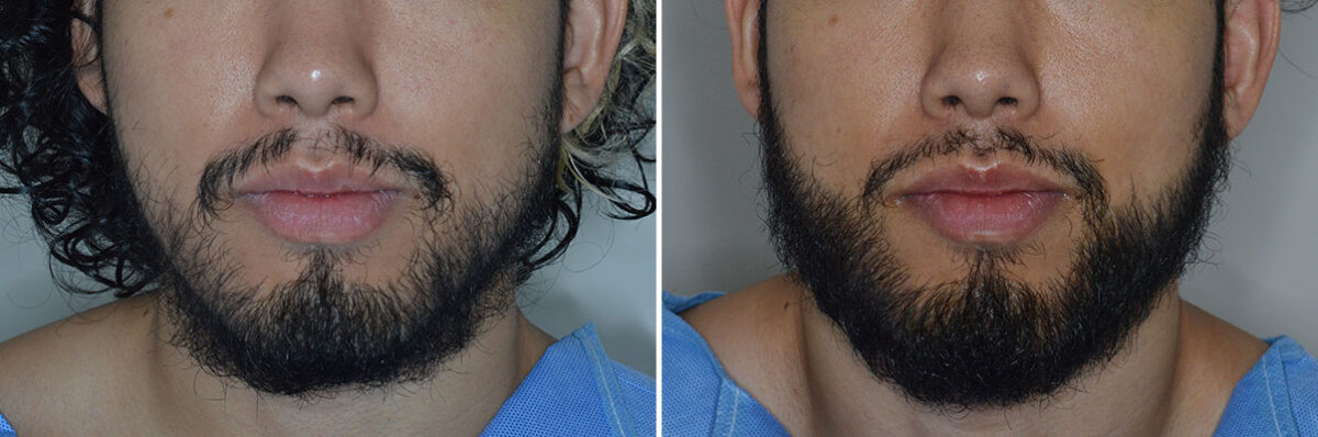 Beard Transplant Before and After Photos in Miami, FL, Patient 7921