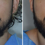 Beard Transplant Before and After Photos in Miami, FL, Patient 7921