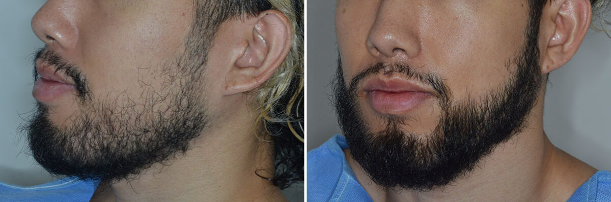 Beard Transplant Before and After Photos in Miami, FL, Patient 7921