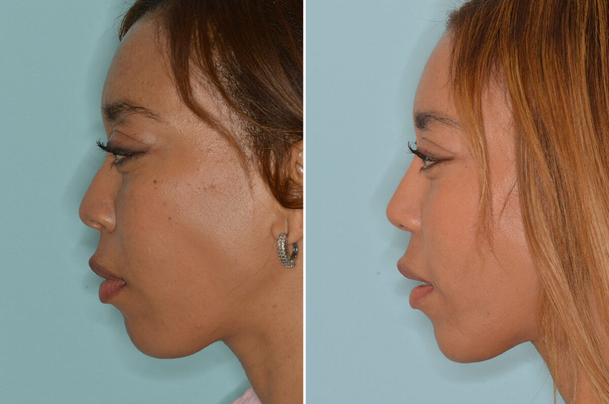 Ethnic Rhinoplasty Before and After Photos in Miami, FL, Patient 7939