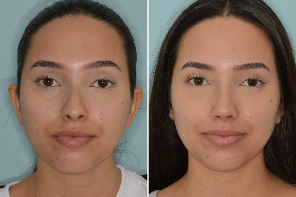 Rhinoplasty Before and After Photos in Miami, FL, Patient 7949