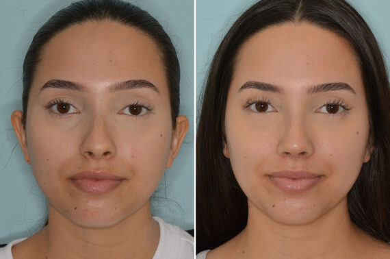 Rhinoplasty Before and After Photos in Miami, FL, Patient 7949