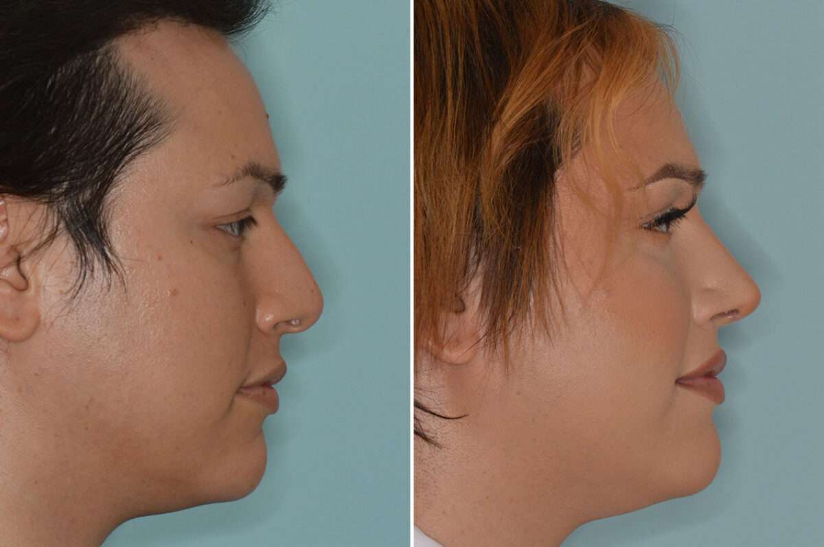 Rhinoplasty Before and After Photos in Miami, FL, Patient 7959