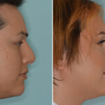 Rhinoplasty Before and After Photos in Miami, FL, Patient 7959