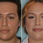 Rhinoplasty Before and After Photos in Miami, FL, Patient 7959