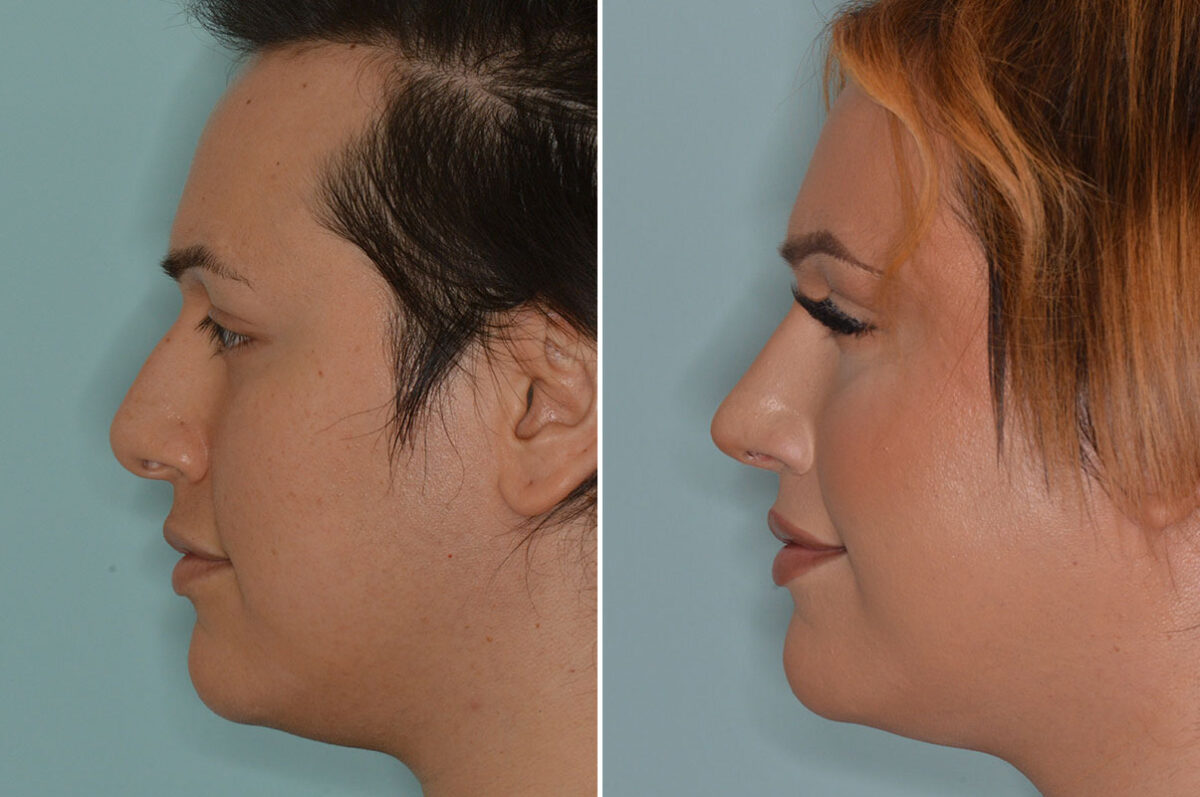 Rhinoplasty Before and After Photos in Miami, FL, Patient 7959