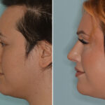 Rhinoplasty Before and After Photos in Miami, FL, Patient 7959