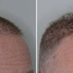 Hair Transplant Before and After Photos in Miami, FL, Patient 7973